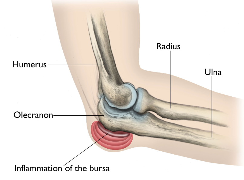 Ontstoken slijmbeurs achteraan de elleboog (bursitis olecrani)