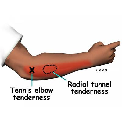 Pijnpunten bij radiaal tunnel syndroom, naast die van een tenniselleboog