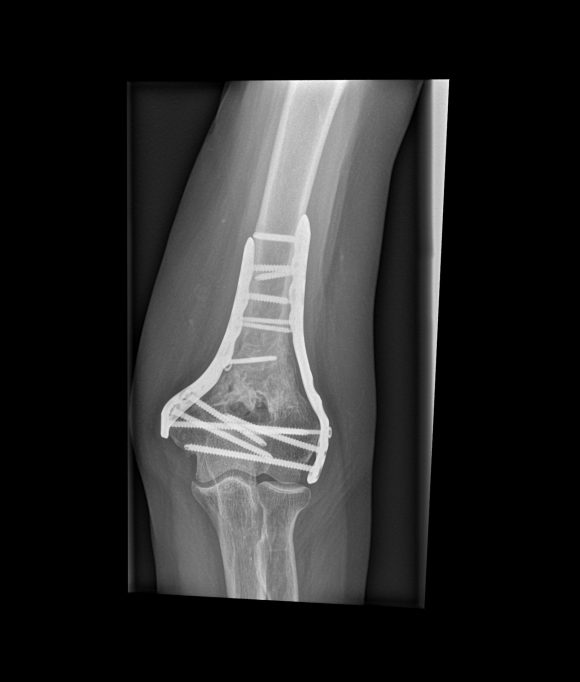 Postoperatieve röntgenfoto van een supracondylaire elleboogbreuk gefixeerd met platen en schroeven