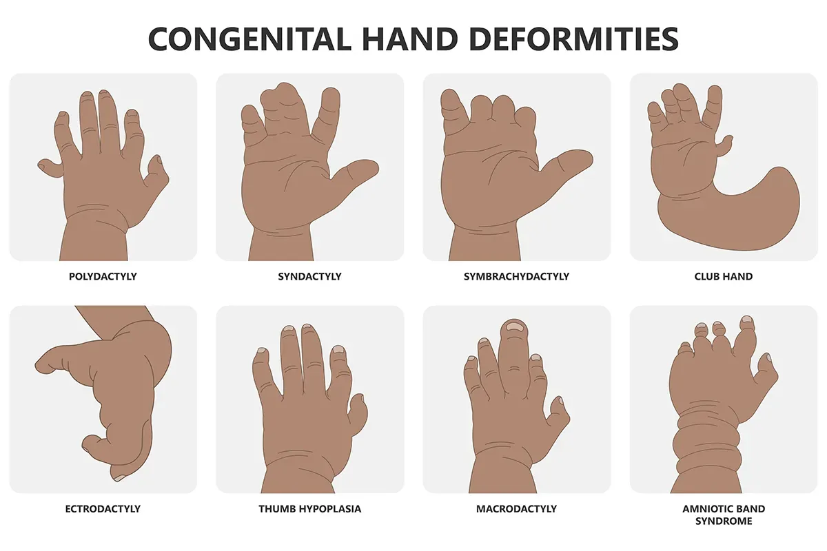 Aangeboren afwijkingen van de hand: extra vinger, vergroeide vingers en een kromme hand