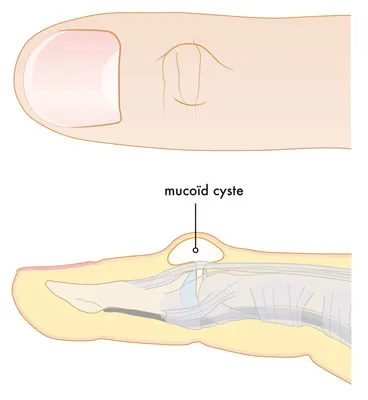 Mucoïde cyste op de vinger, een kleine zwelling vlak bij het nagelgewricht