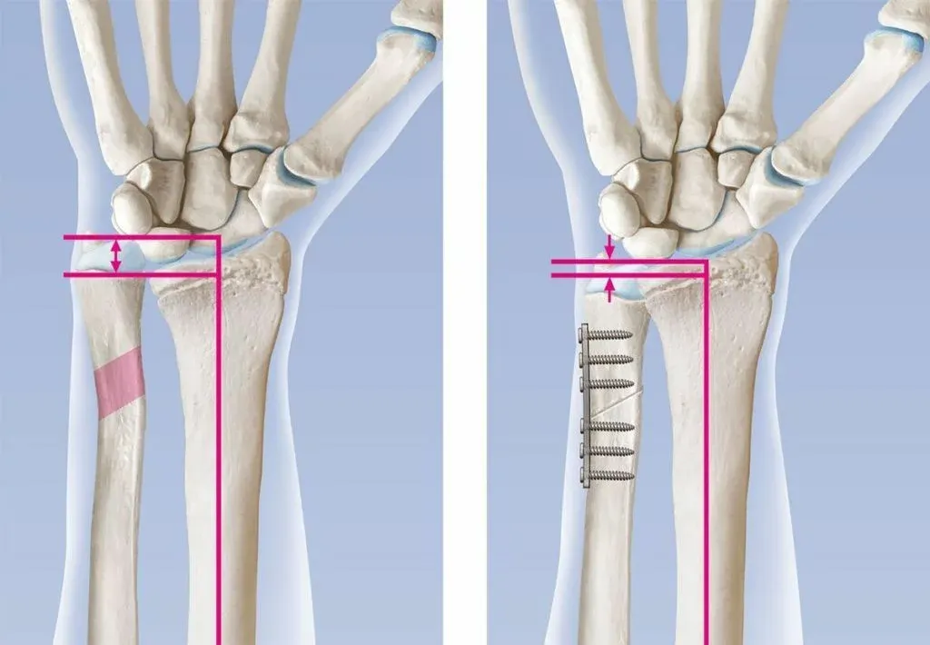 Verkorting van de ellepijp (ulna) met een plaat, bij een TFCC-letsel