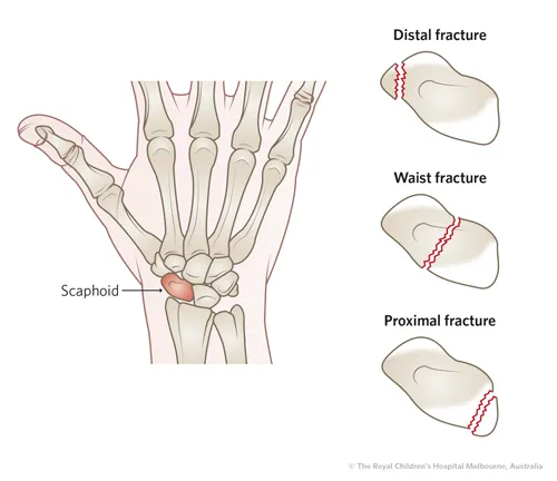 Breuk van het scaphoid, het bootvormige botje in de pols