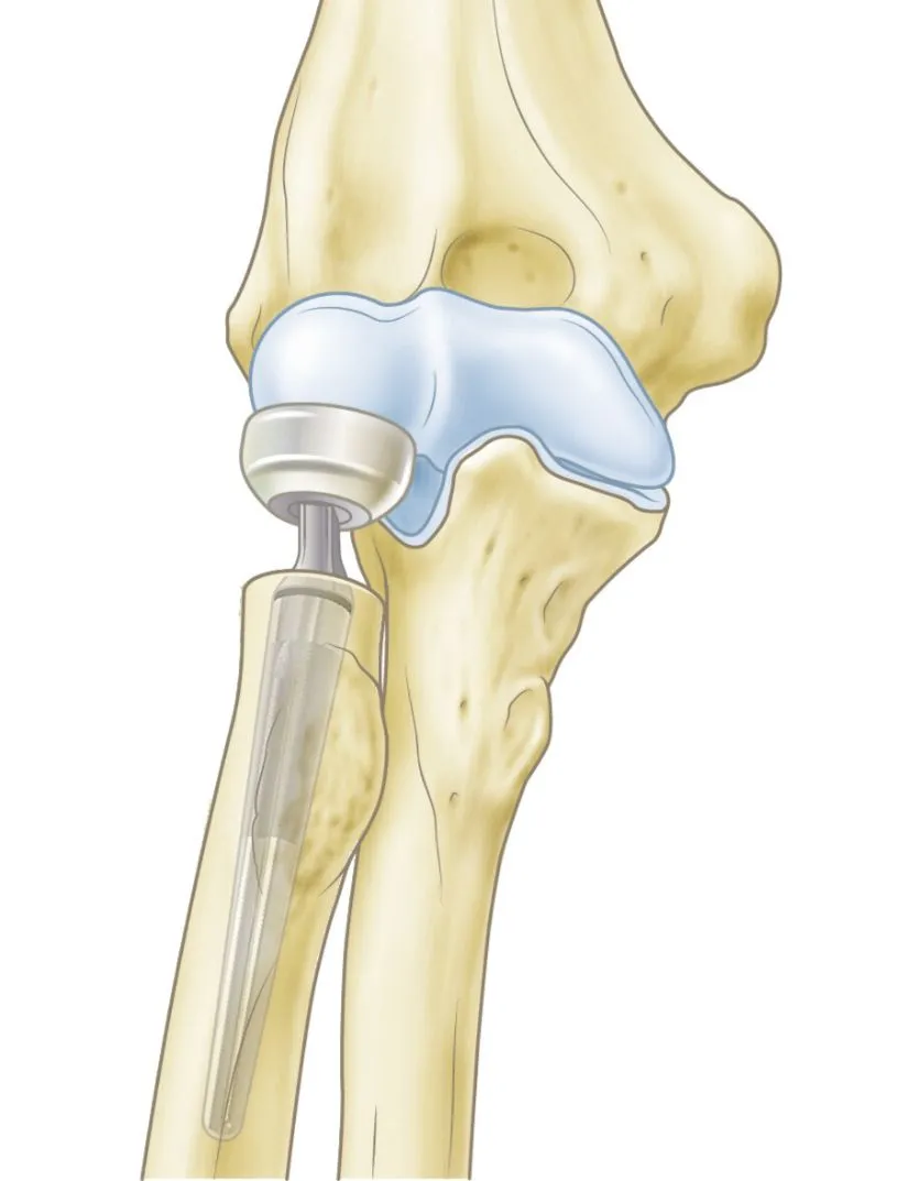 Radiuskopbreuk: prothese op rontgenbeeld - Orthopedie Turnhout.