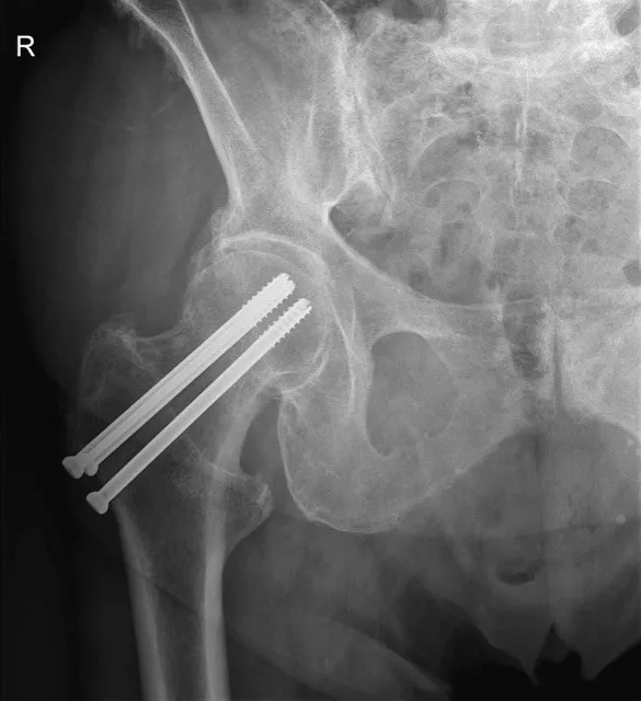 Heupfractuur: gecannuleerde schroeven op rontgenbeeld - Orthopedie Turnhout.
