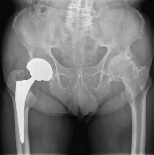 Heupfractuur: prothese op rontgenbeeld - Orthopedie Turnhout.