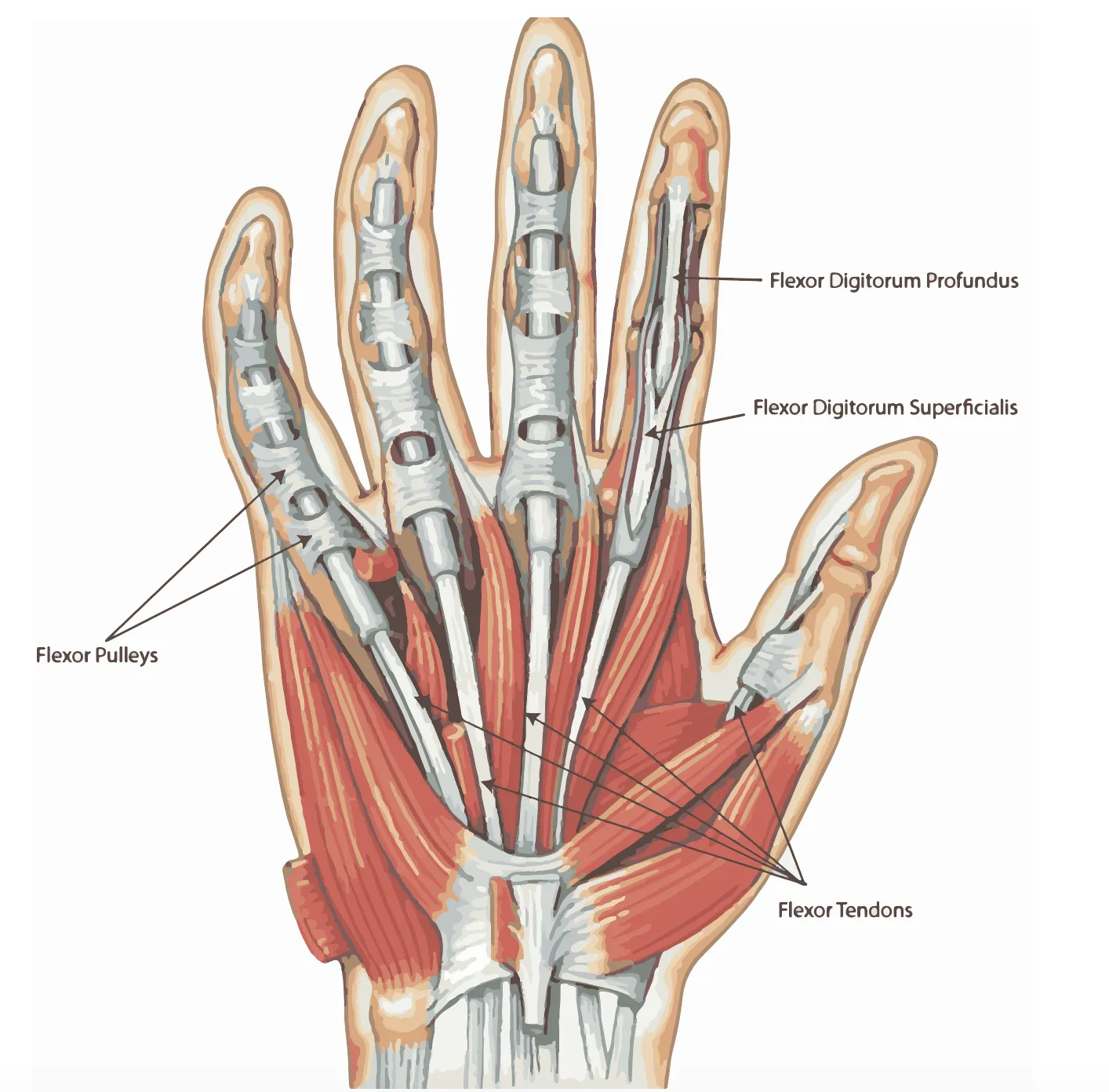 Anatomische illustratie van peesletsels aan de buigpezen van de hand met snijwond door buigpees