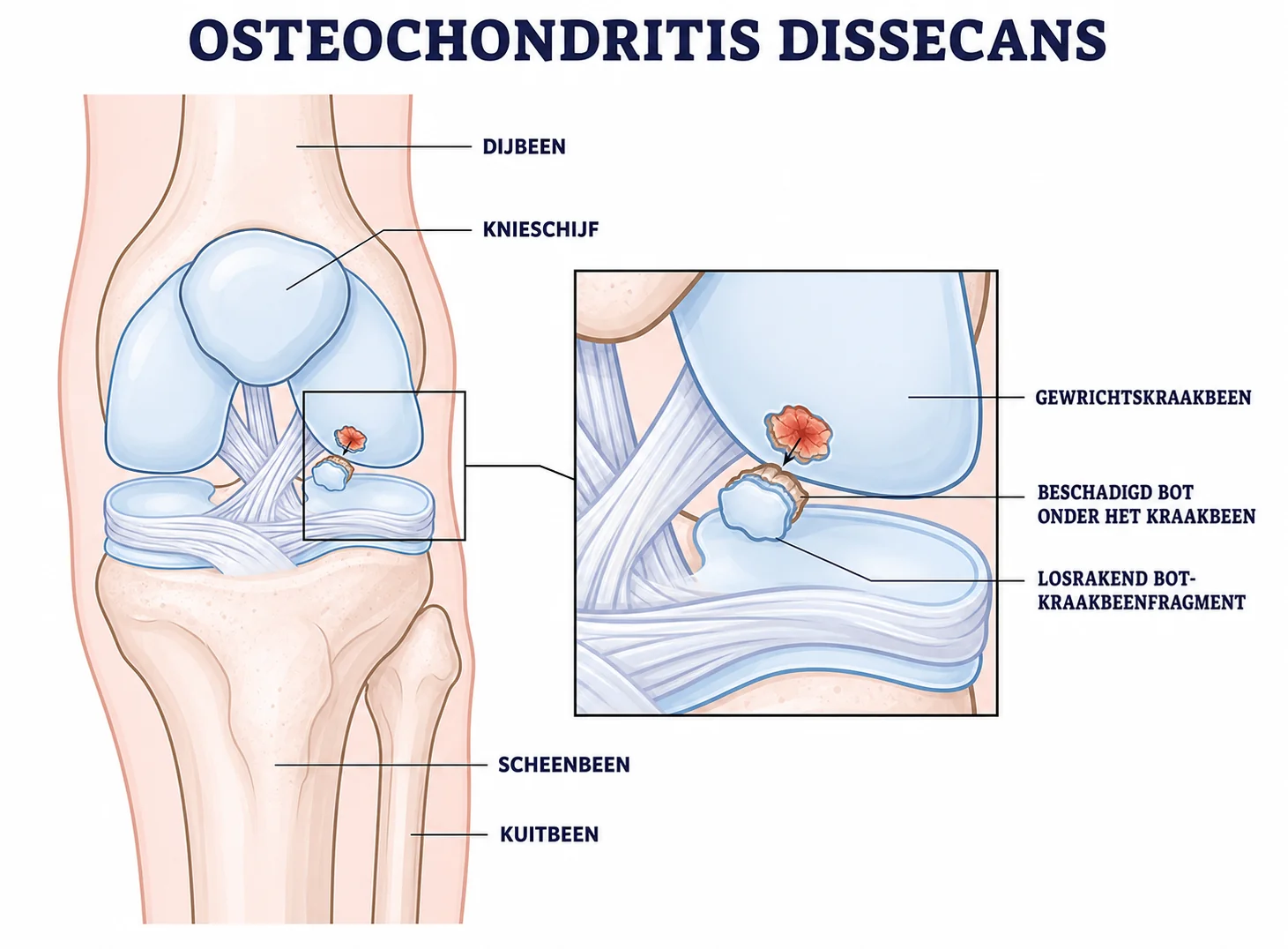Illustratie van beschadigd bot en kraakbeen en een losrakend fragment bij osteochondritis dissecans