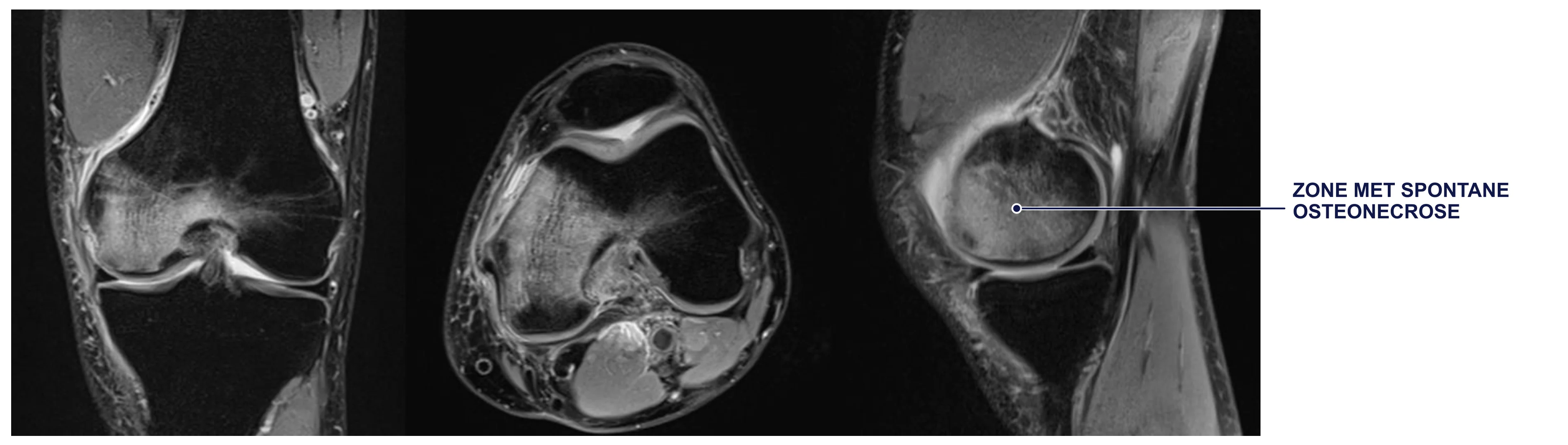 MRI-beelden van de knie met aanduiding van de zone met spontane osteonecrose