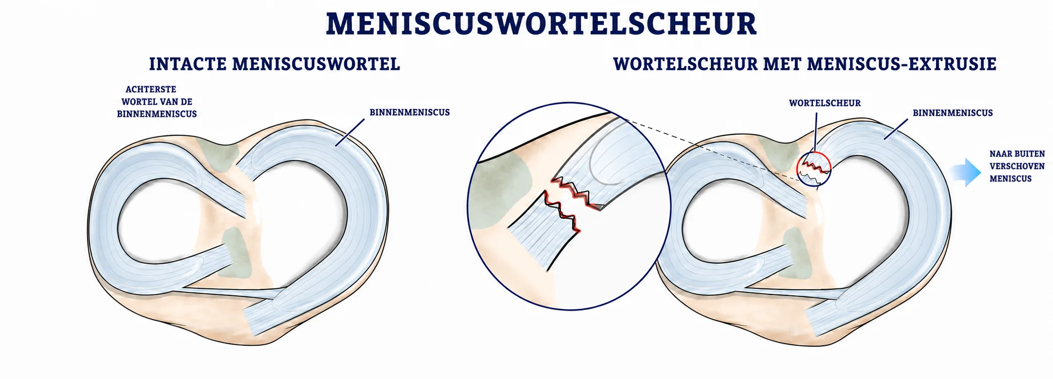 Vergelijking van een intacte achterste meniscuswortel met een wortelscheur