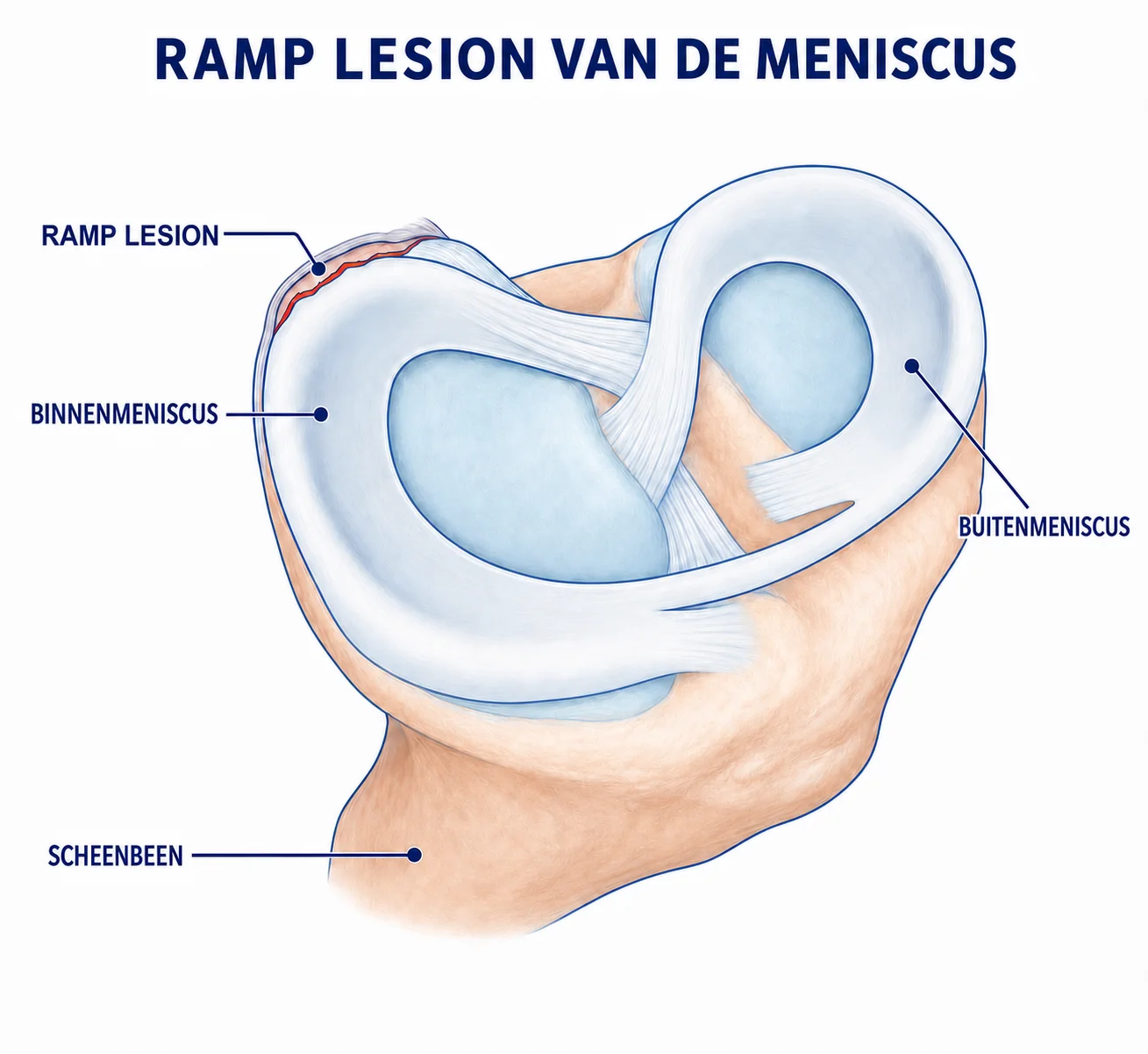 Illustratie van een rampscheur aan de achterhoorn van de binnenmeniscus