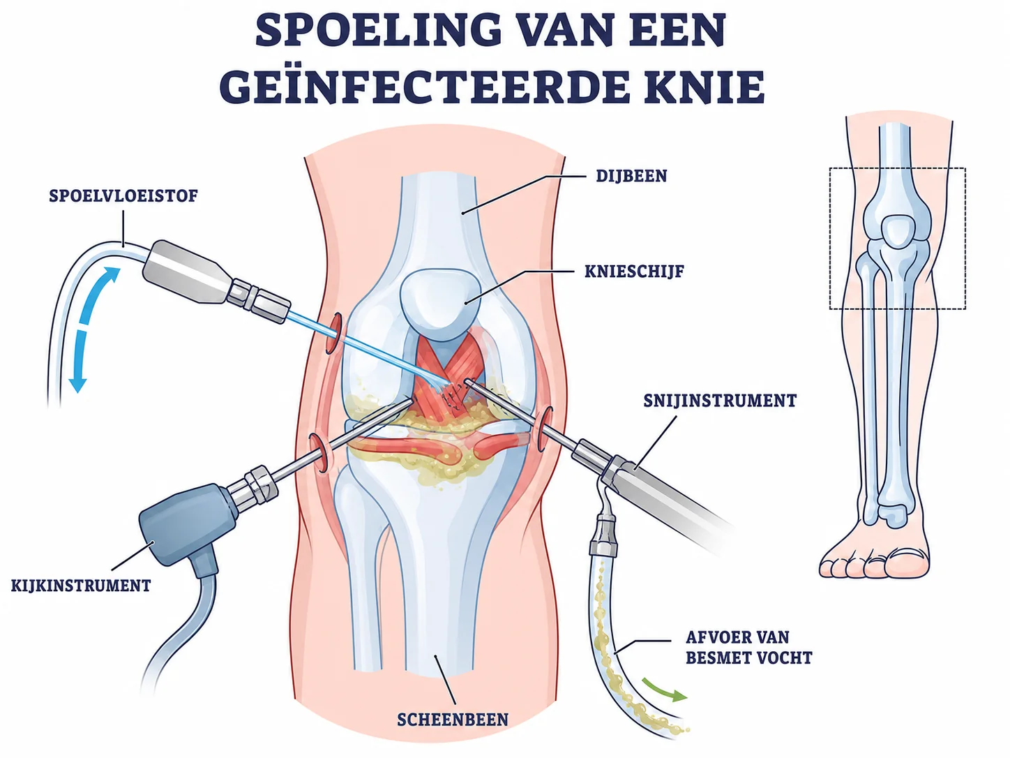 Illustratie van kijkoperatieve spoeling en afvoer van besmet vocht uit de knie
