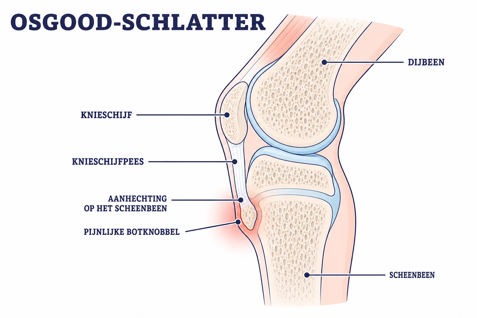 Anatomische illustratie van de pijnlijke botknobbel bij Osgood-Schlatter