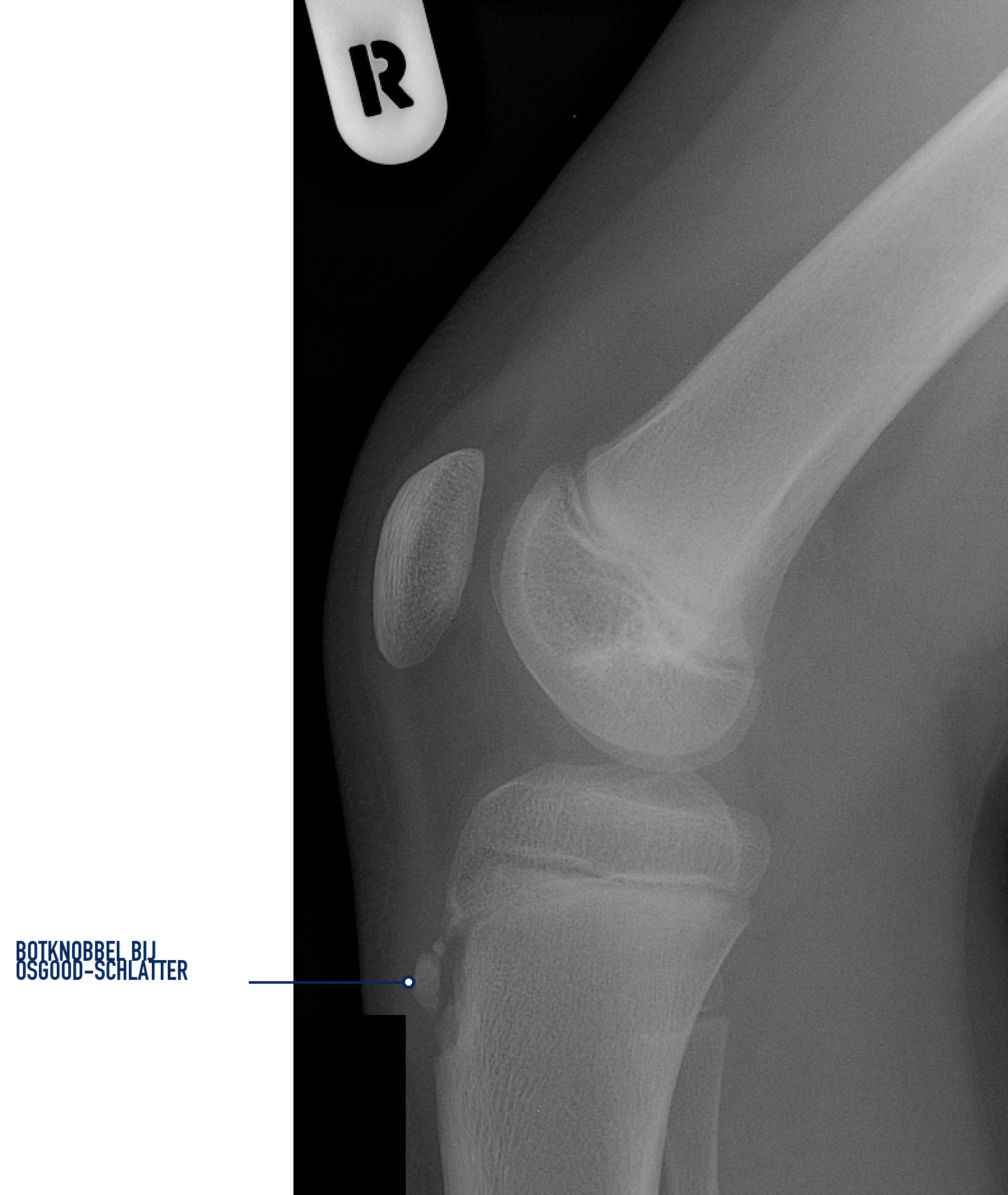 Röntgenfoto in zijaanzicht met aanduiding van de botknobbel bij Osgood-Schlatter