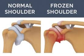 Tekening van een gezond schouderkapsel naast een ingekrompen, ontstoken kapsel bij een frozen shoulder