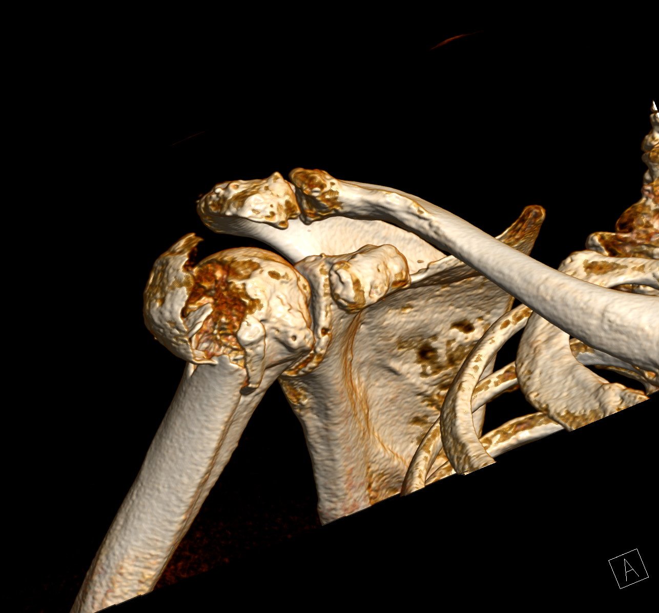 3D-CT-beeld van een breuk van de bovenarmkop