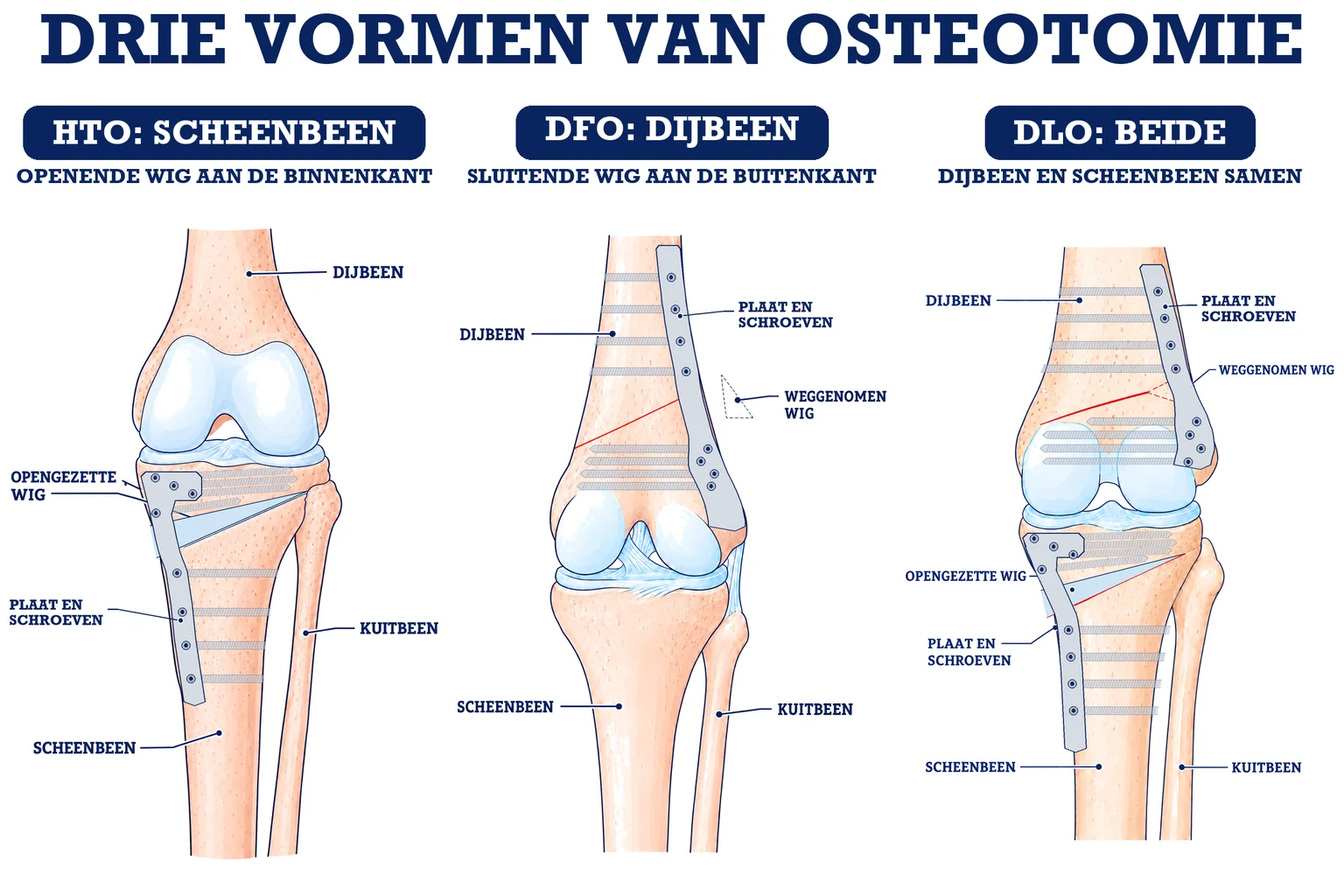 Illustratie van drie knieën die tonen waar de chirurg het bot doorzaagt bij een hoge tibiale osteotomie, een distale femurosteotomie en een osteotomie op beide niveaus
