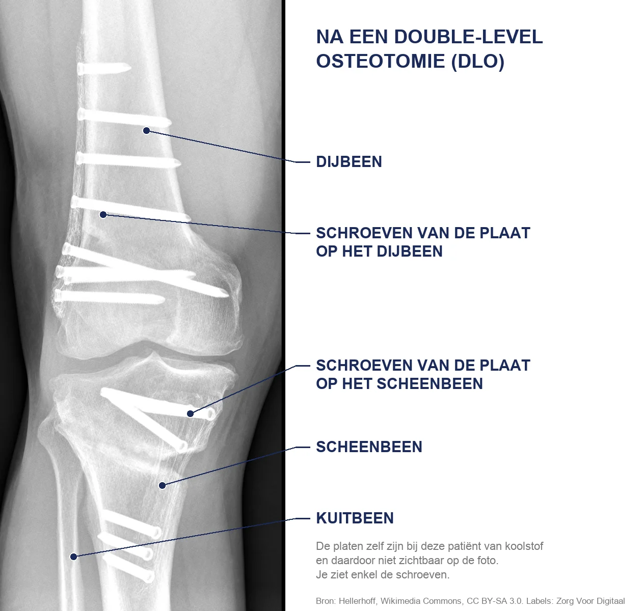 Röntgenfoto van een knie na een double-level osteotomie, met de schroeven van een plaat op het dijbeen en een plaat op het scheenbeen
